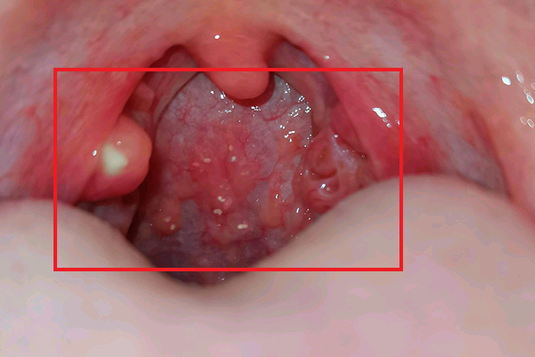 慢性肥厚性咽炎滤泡增生图 慢性肥厚性咽炎滤泡增生图