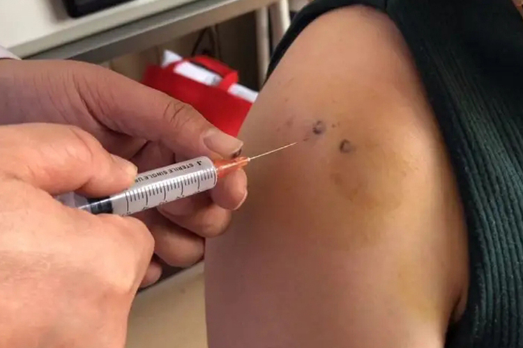 肩关节内注射玻璃酸钠位置图