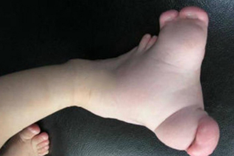 巨指畸形脚部症状图