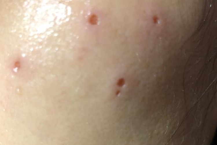 激光点痣刚点完皮肤图