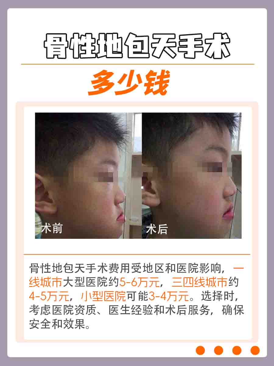 骨性地包天手术费用解析