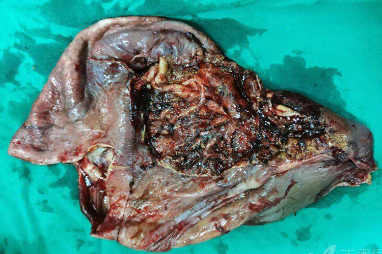 肝脏包虫图 肝脏包虫图