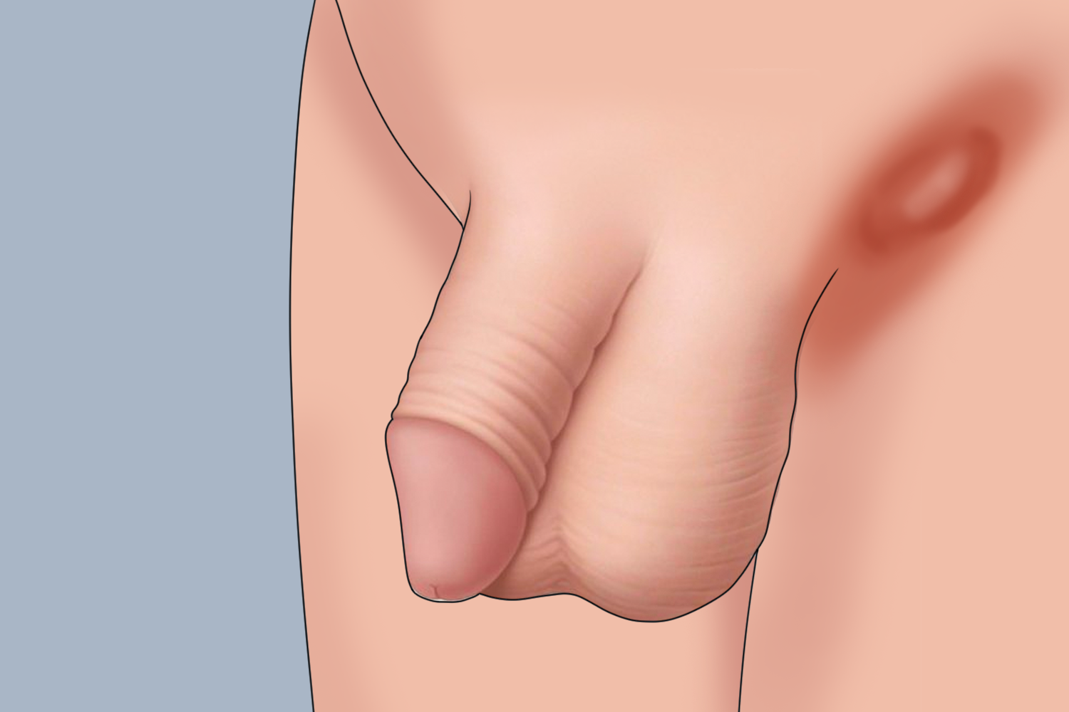 腹股沟淋巴结肿大图片