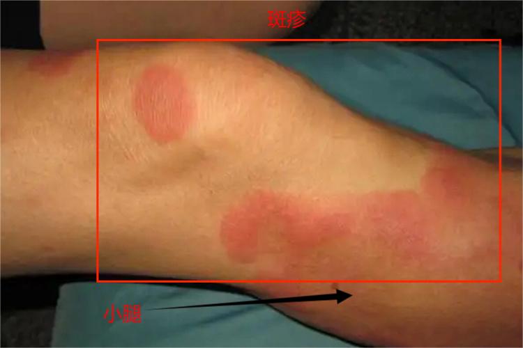 固定性红斑小腿大块斑疹图