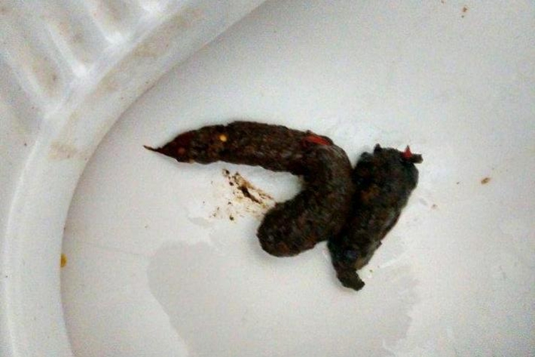 癌症标准黑便图