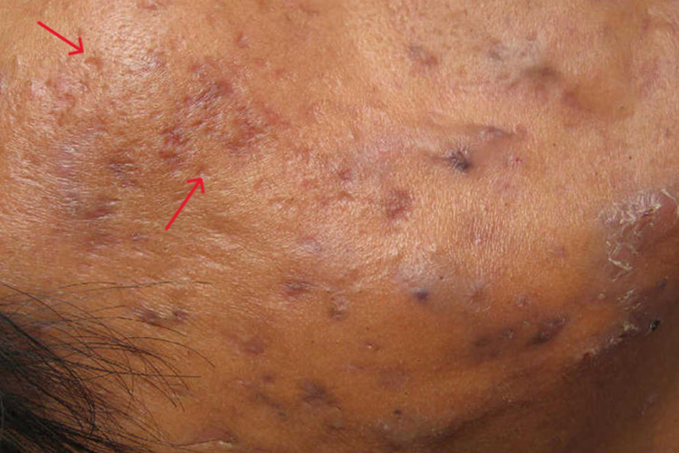 痘坑多且深伴皮肤薄图