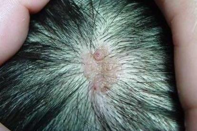皮脂腺毛囊瘤头皮症状图 皮脂腺毛囊瘤头皮症状图