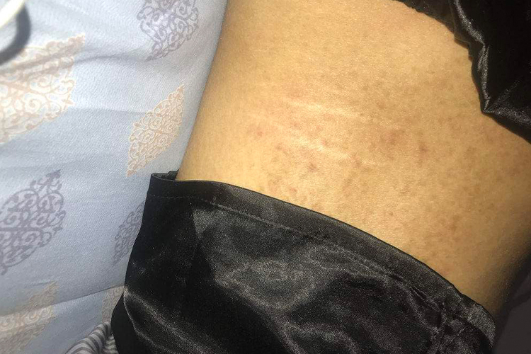 湿疹导致的女性后腰皮肤发黑图