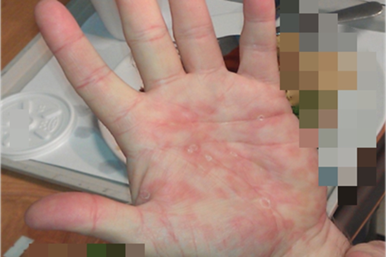 乙型肝炎抗原血症手掌红斑图