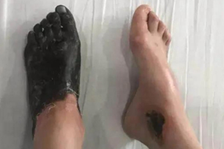 闭塞性血栓性脉管炎第三期症状图