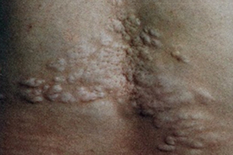 结缔组织痣背部症状图