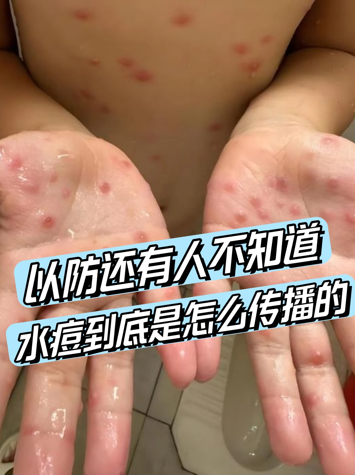 以防还有人不知道，水痘到底是怎么传播的