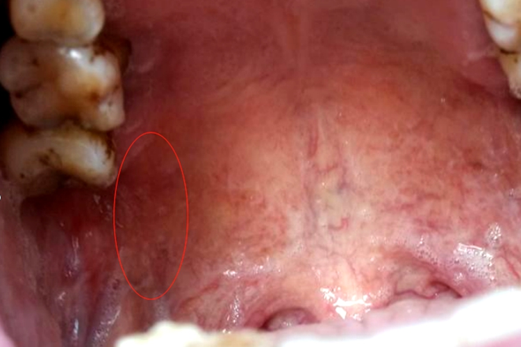 上牙慢性根尖周炎图 上牙慢性根尖周炎图