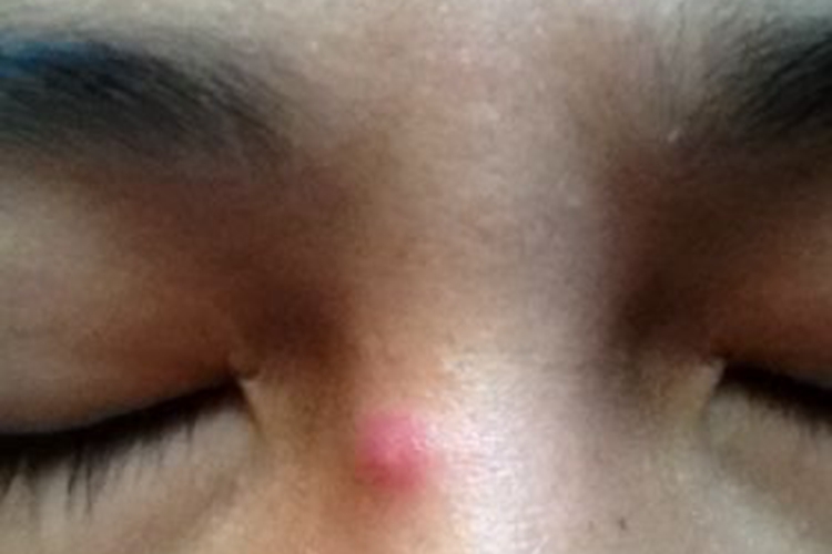 眼角鼻梁处痤疮图 眼角鼻梁处痤疮图