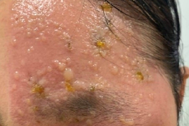 带状疱疹面部出现红肿水疱图