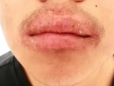 剥脱性唇炎嘴唇红肿脱屑图.jpeg