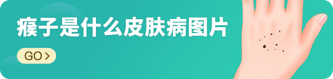瘊子是什么皮肤病图片