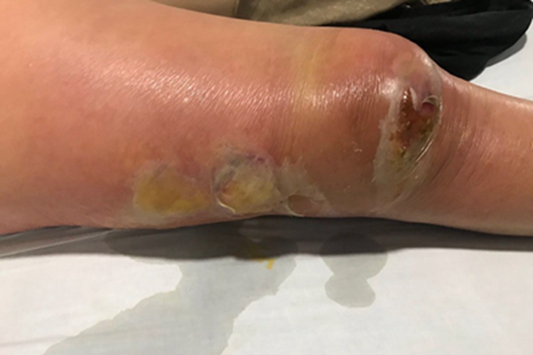 类脂质渐进性坏死皮肤变肿图 类脂质渐进性坏死皮肤变肿图