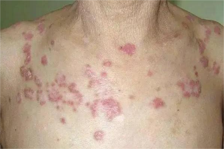 离心性环状红斑胸部丘疹红斑图 离心性环状红斑胸部丘疹红斑图