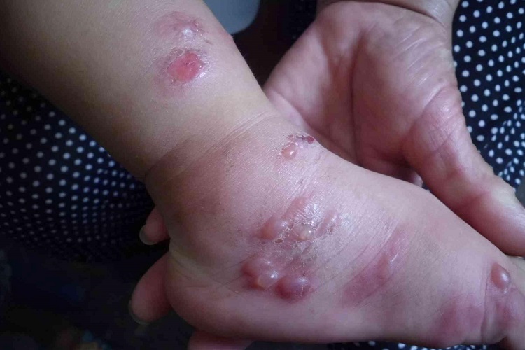 昆虫性皮炎脚踝小水疱图