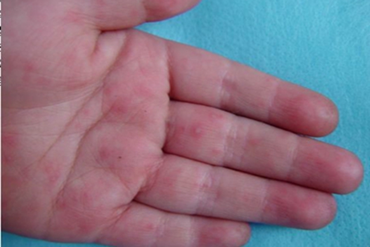 手足口病手部丘疹图