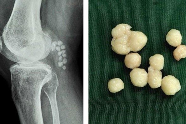 膝关节游离体图