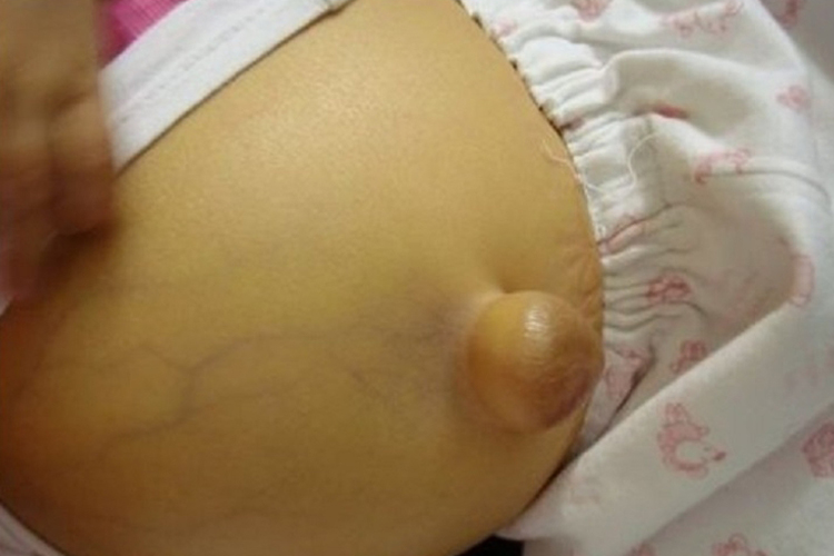 肚脐眼异常情况图