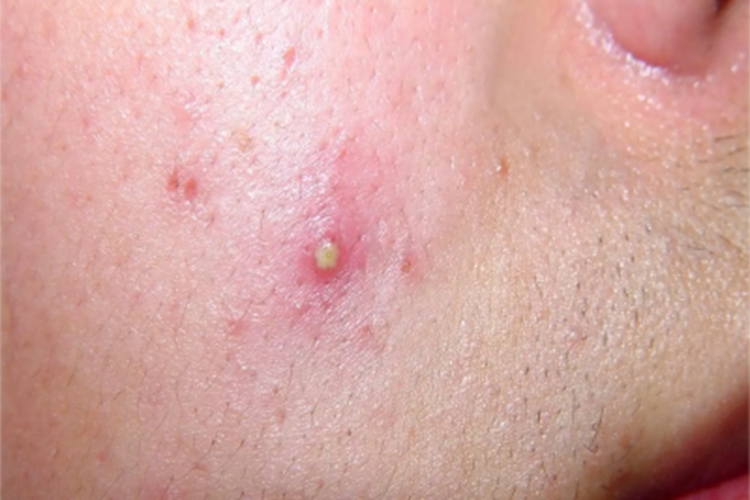 颜面疖痈面部症状图 颜面疖痈面部症状图