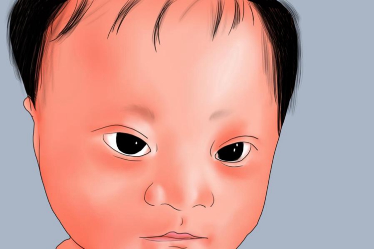 21-三体综合征面容图