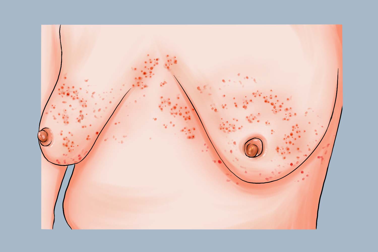 乳头湿疹周围小疙瘩图