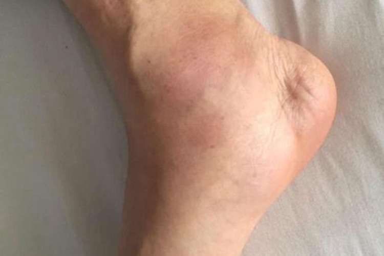 痛风脚踝内侧肿图 痛风脚踝内侧肿图