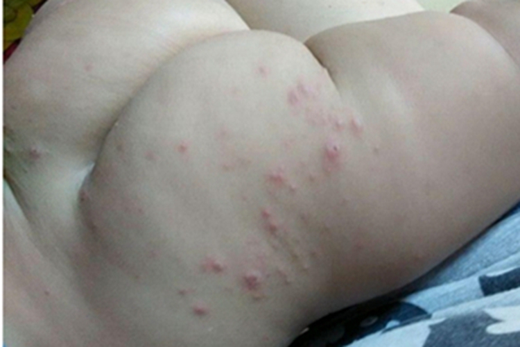 手足口病臀部小红疙瘩图
