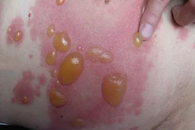 水疱可推动图 水疱可推动图