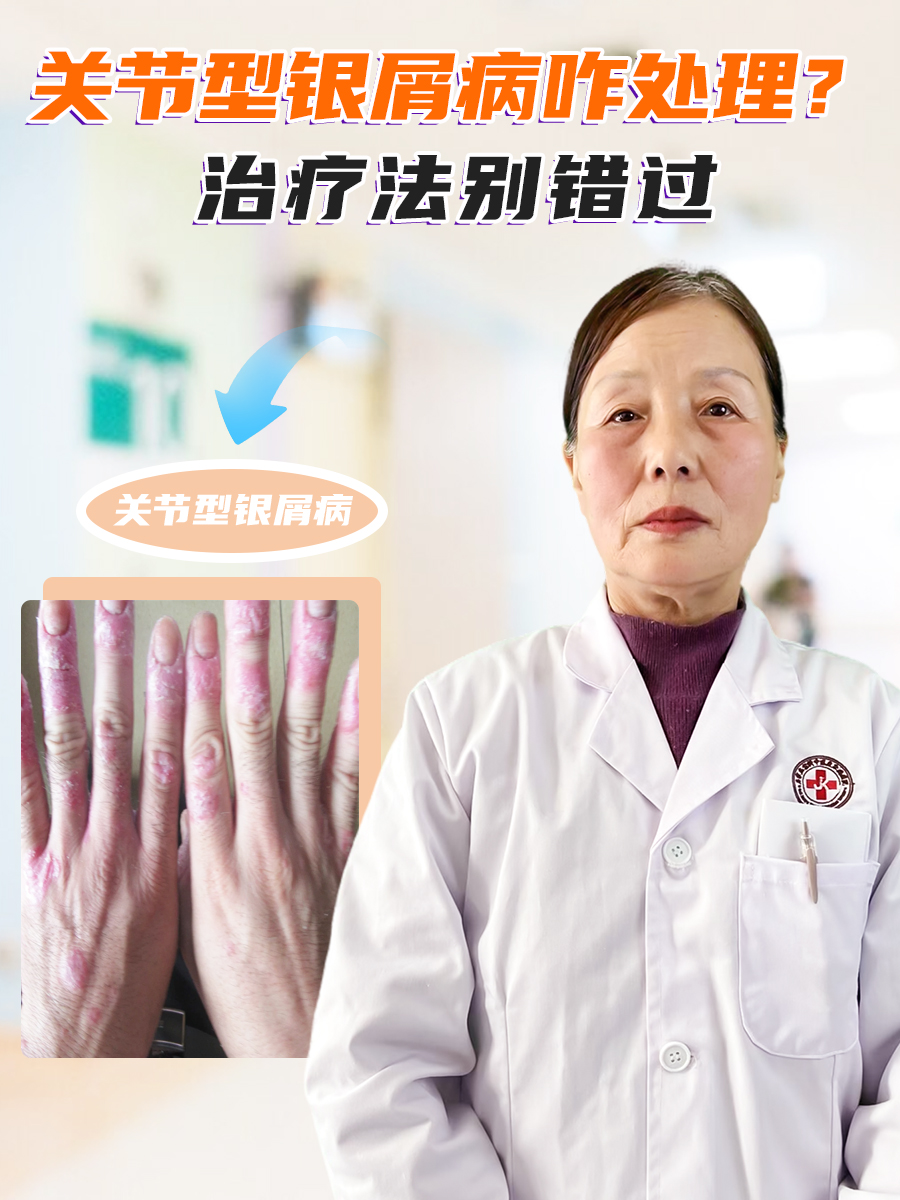 关节型银屑病咋处理?治疗法别错过
