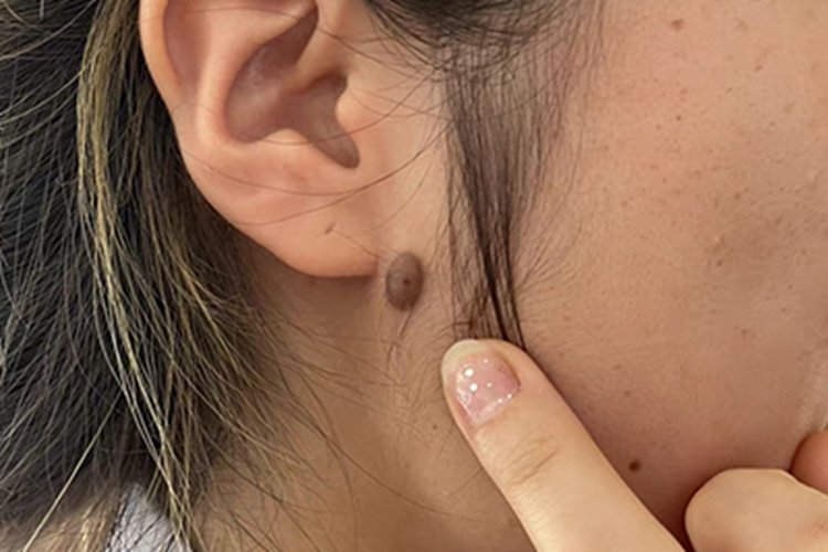 复合痣耳周有黑色疙瘩图