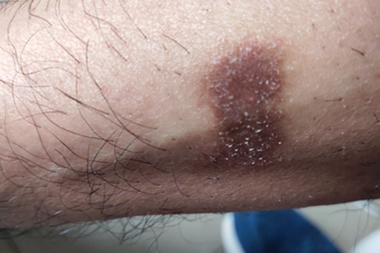 慢性湿疹小腿斑图