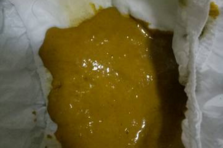 坏死性小肠炎糊状便图