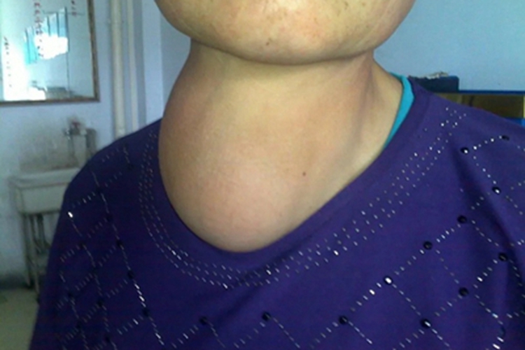 单纯性甲状腺肿脖子有肿块图 单纯性甲状腺肿脖子有肿块图