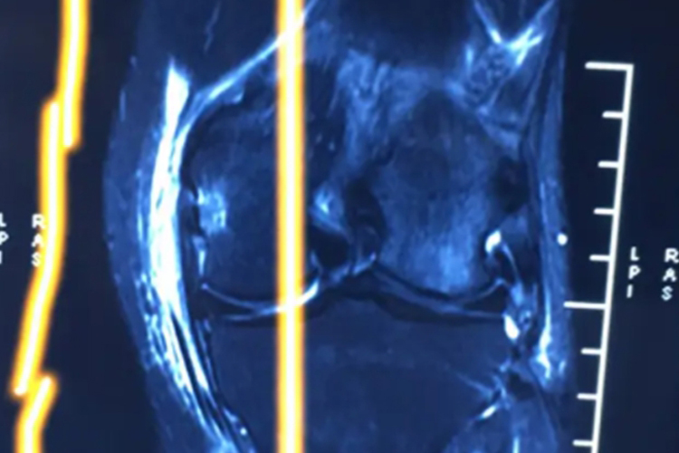 内侧副韧带损伤图