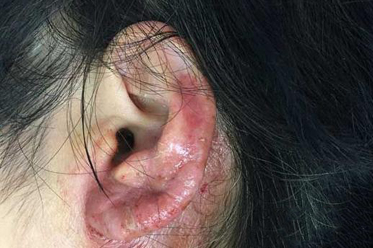 耳洞发炎溃烂图