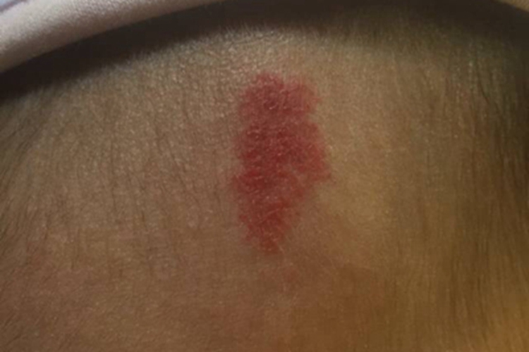 蔓状血管瘤前额症状图 蔓状血管瘤前额症状图