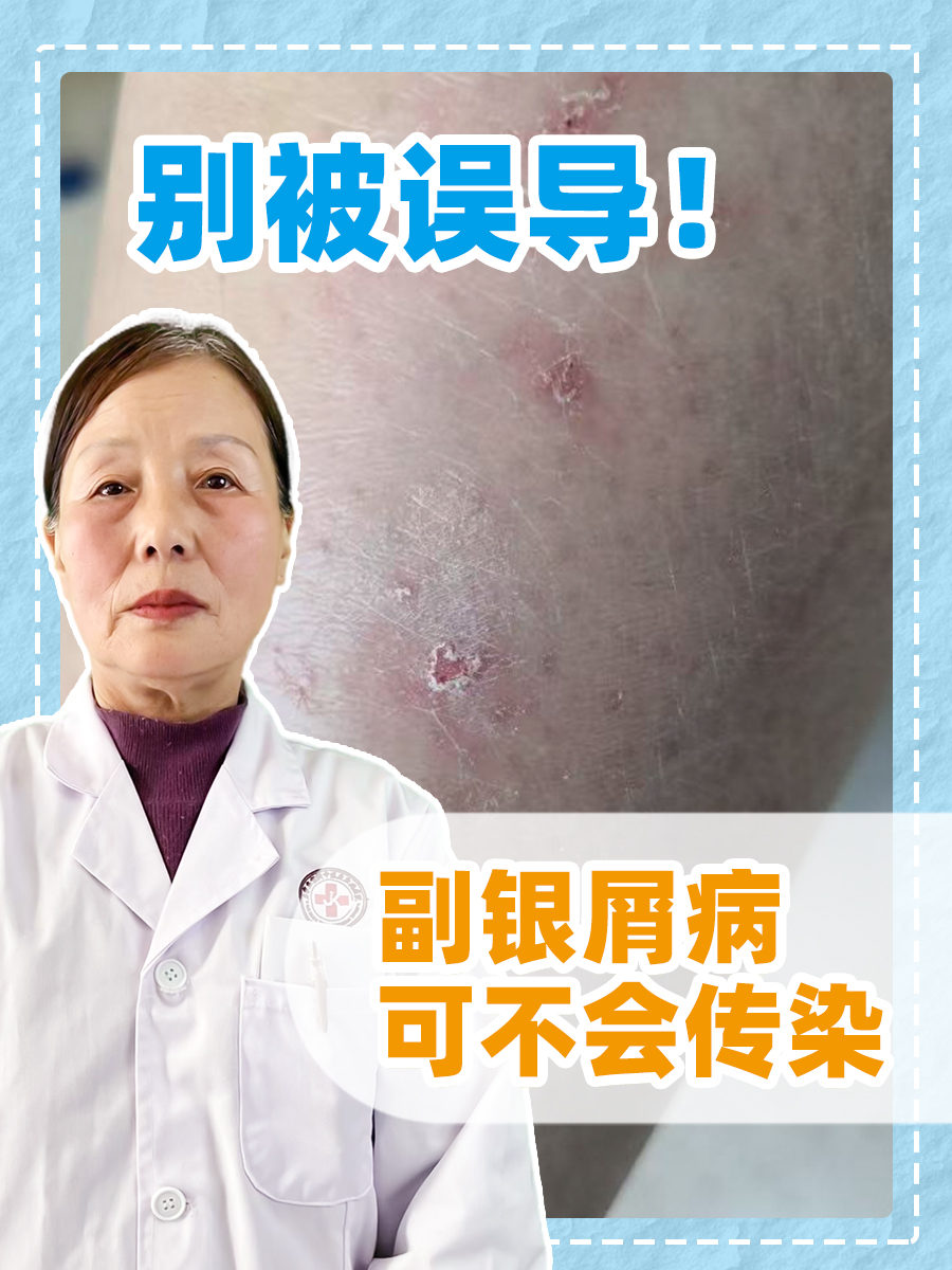 别被误导!副银屑病可不会传染