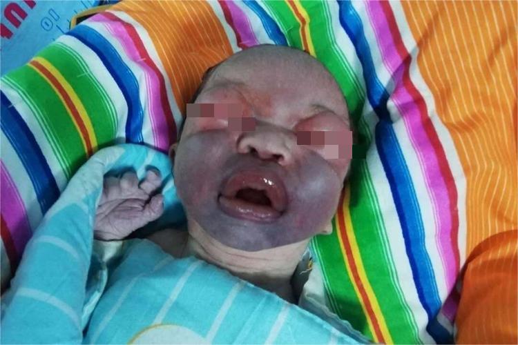 新生儿挤压面部青紫图 新生儿挤压面部青紫图