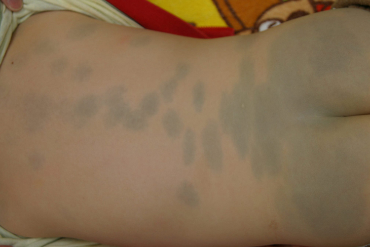 新生儿蒙古斑图 新生儿蒙古斑图