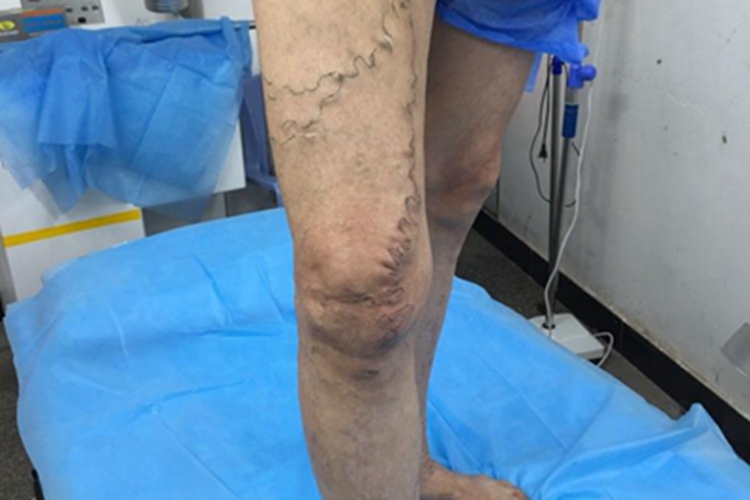 大隐静脉曲张大腿皮肤发青图