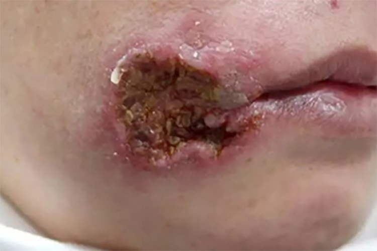 梅毒性树胶肿图 梅毒性树胶肿图