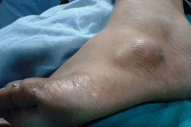 腱鞘囊肿图 腱鞘囊肿图