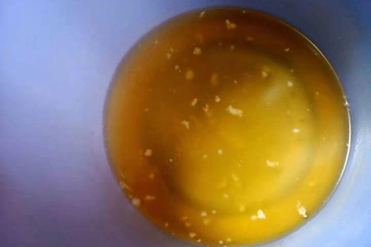 肾结石尿液里有白色皮屑图