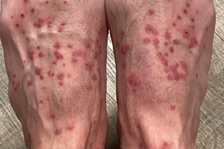 恙螨皮炎脚背症状图 恙螨皮炎脚背症状图