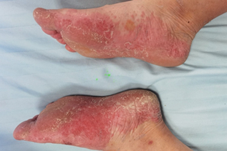 多形红斑型药疹脚底脱皮图 多形红斑型药疹脚底脱皮图